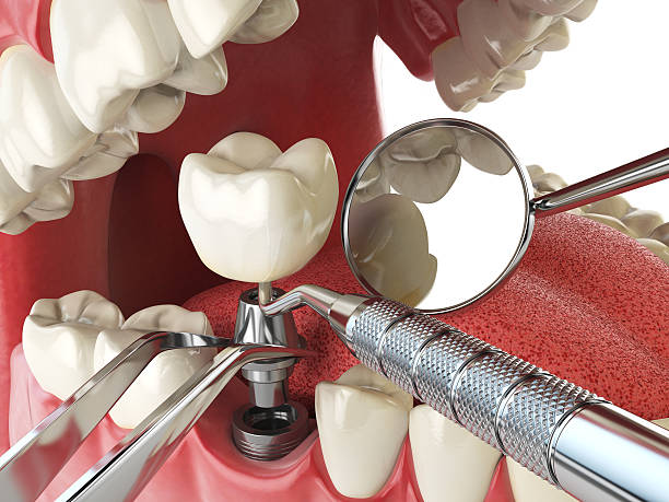 Best Urgent Care for Lost Fillings or Crowns in Rohnert Park, CA